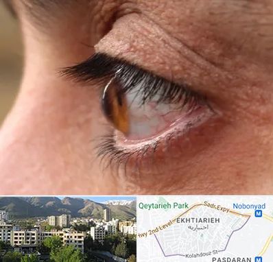 متخصص قوز قرنیه در اختیاریه 