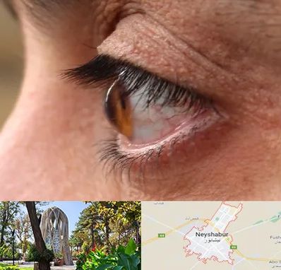 متخصص قوز قرنیه در نیشابور