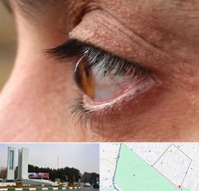 متخصص قوز قرنیه در بلوار فلسیطین مشهد