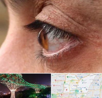 متخصص قوز قرنیه در منطقه 3 تهران 