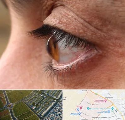 متخصص قوز قرنیه در الهیه مشهد