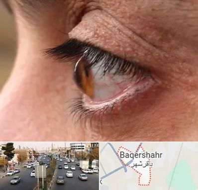 متخصص قوز قرنیه در باقرشهر