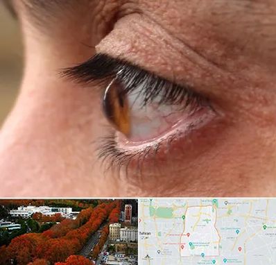 متخصص قوز قرنیه در منطقه 6 تهران 