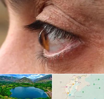 متخصص قوز قرنیه در رودبار