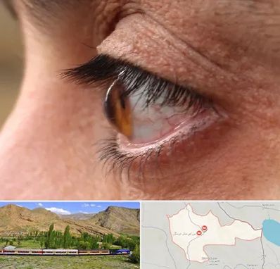 متخصص قوز قرنیه در خاش