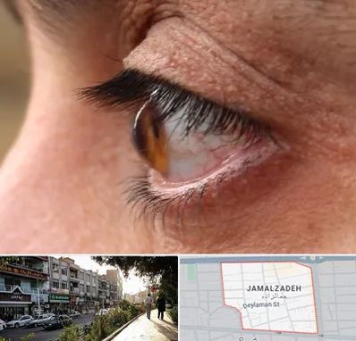 متخصص قوز قرنیه در خیابان جمالزاده