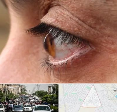 متخصص قوز قرنیه در سیدی مشهد