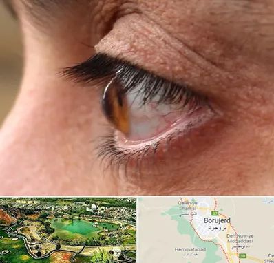 متخصص قوز قرنیه در بروجرد