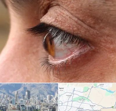 متخصص قوز قرنیه در شمال شرق تهران