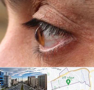 متخصص قوز قرنیه در سعادت آباد 