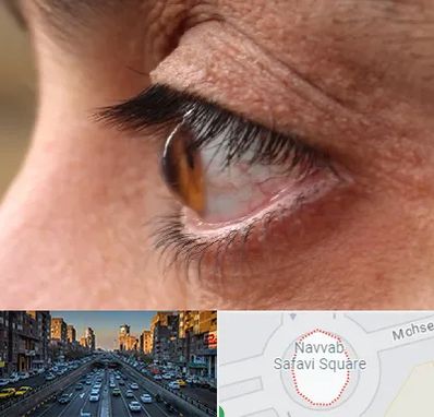 متخصص قوز قرنیه در نواب