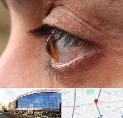 متخصص قوز قرنیه در نصف راه تبریز