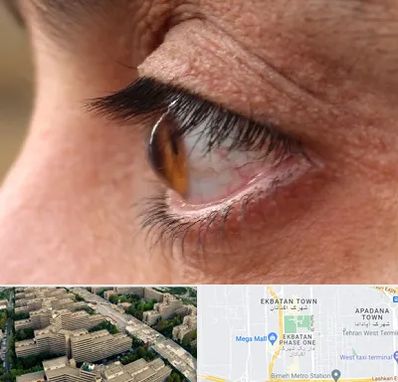 متخصص قوز قرنیه در اکباتان 