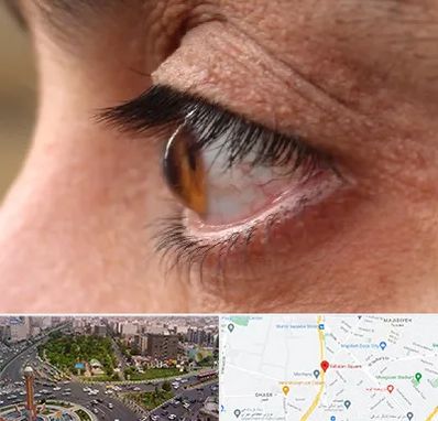 متخصص قوز قرنیه در سبلان 