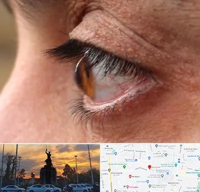 متخصص قوز قرنیه در میدان حر 