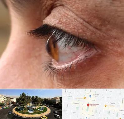 متخصص قوز قرنیه در هفت حوض 