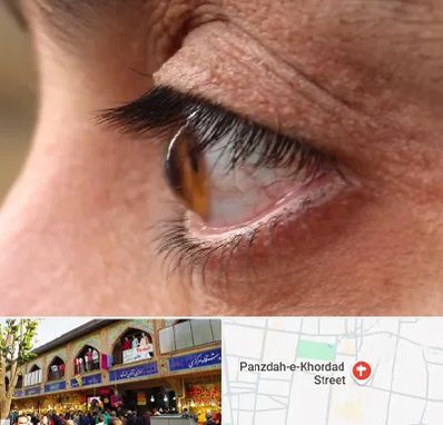 متخصص قوز قرنیه در 15 خرداد