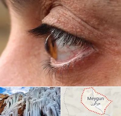 متخصص قوز قرنیه در میگون