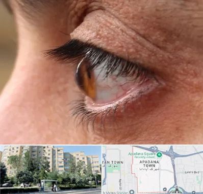 متخصص قوز قرنیه در آپادانا