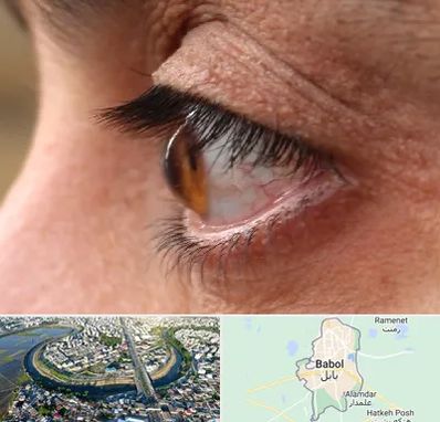 متخصص قوز قرنیه در بابل