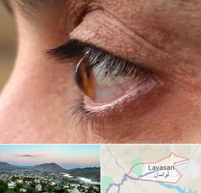 متخصص قوز قرنیه در لواسان