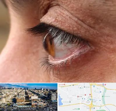 متخصص قوز قرنیه در شهرک راه آهن