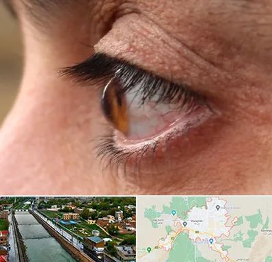 متخصص قوز قرنیه در مراغه