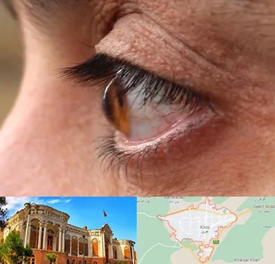 متخصص قوز قرنیه در خوی