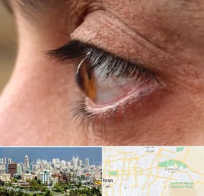 متخصص قوز قرنیه در شرق تهران 