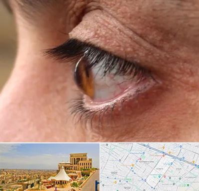 متخصص قوز قرنیه در هاشمیه مشهد