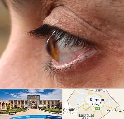 متخصص قوز قرنیه در کرمان