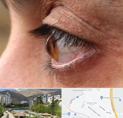 متخصص قوز قرنیه در شهر زیبا 