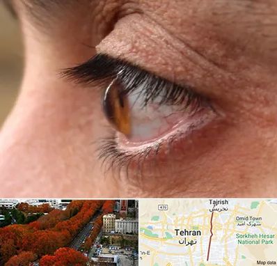 متخصص قوز قرنیه در ولیعصر 