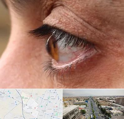 متخصص قوز قرنیه در حصارک کرج