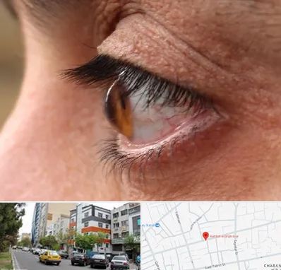 متخصص قوز قرنیه در هفده شهریور تبریز