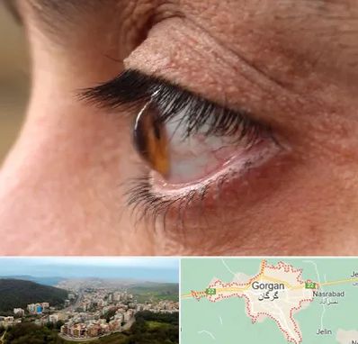 متخصص قوز قرنیه در گرگان