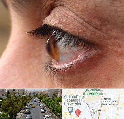 متخصص قوز قرنیه در شهران 