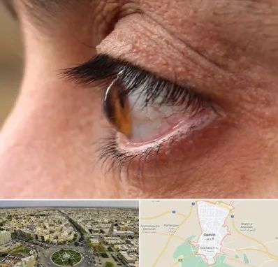 متخصص قوز قرنیه در قزوین