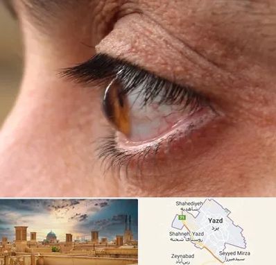متخصص قوز قرنیه در یزد