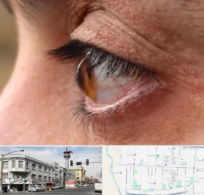 متخصص قوز قرنیه در 17شهریور