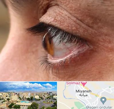 متخصص قوز قرنیه در میانه