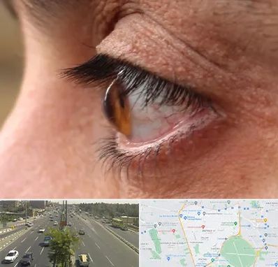 متخصص قوز قرنیه در منطقه 17 تهران 