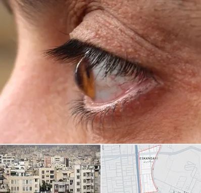 متخصص قوز قرنیه در اسکندری