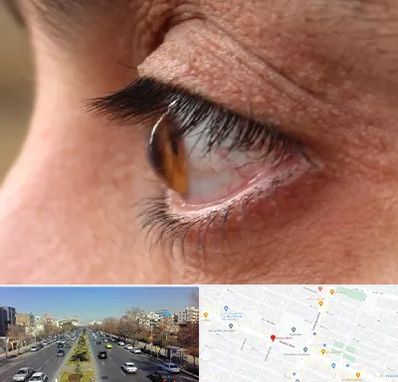 متخصص قوز قرنیه در بلوار معلم مشهد 