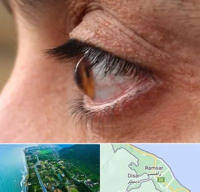 متخصص قوز قرنیه در رامسر