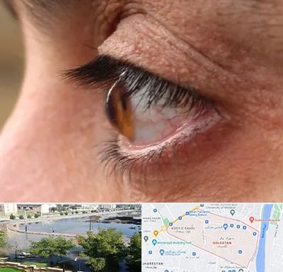 متخصص قوز قرنیه در گلستان اهواز