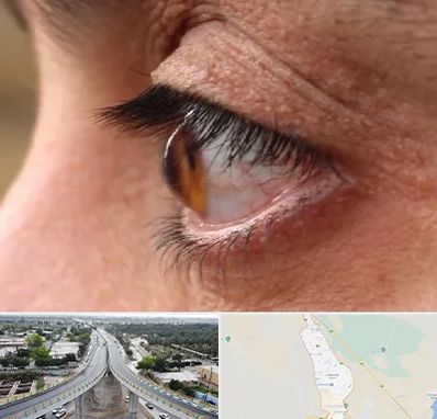 متخصص قوز قرنیه در اندیمشک