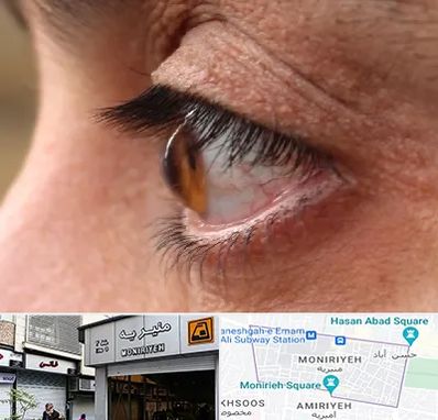 متخصص قوز قرنیه در منیریه 