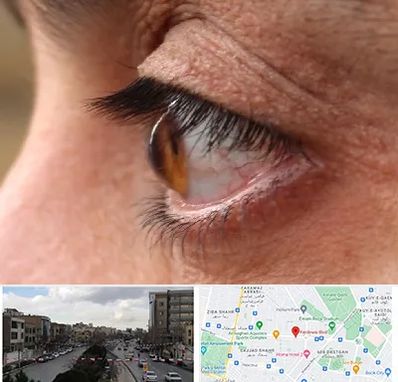 متخصص قوز قرنیه در بلوار فردوسی مشهد 