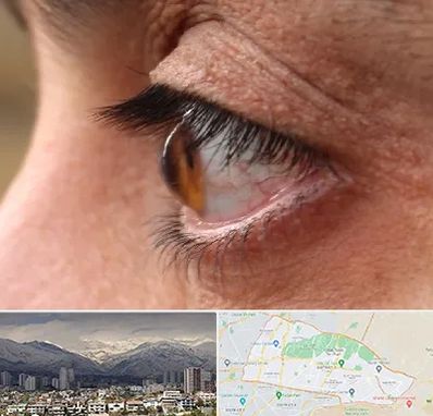 متخصص قوز قرنیه در منطقه 4 تهران 